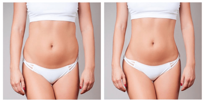 Korean Fat Dissolving Injection Guidance Towards Beauty And Body Perfection Amoa Skin Clinic